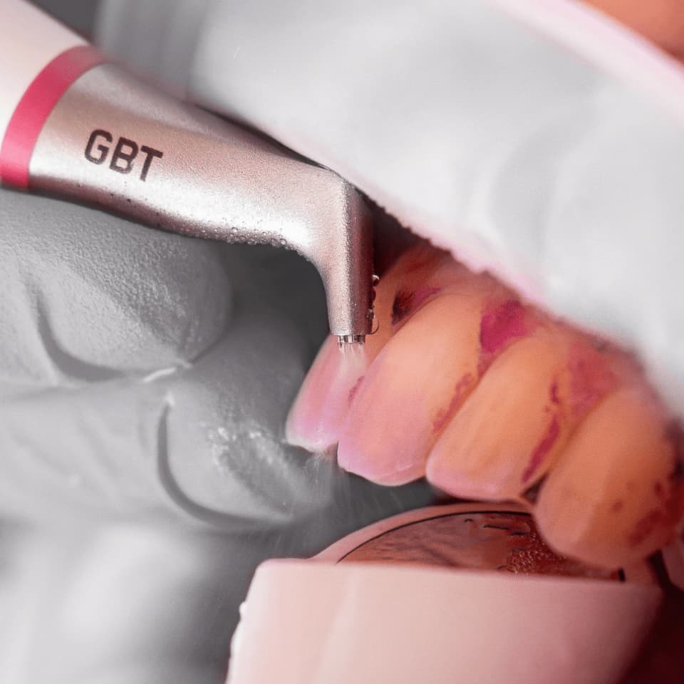 Agora é mais fácil identificar e limpar cáries escondidas com GBT