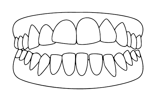 Mordida aberta | Carreira Dental Clinic Mordida aberta