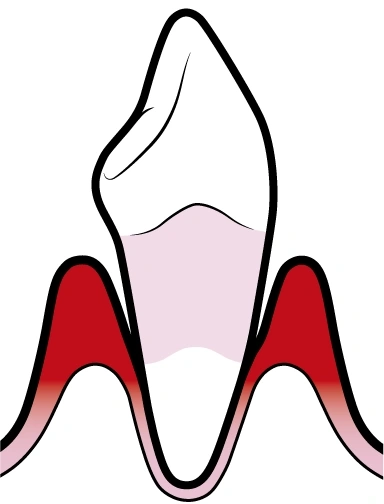 Periodontite | Carreira Dental Clinic Periodontite