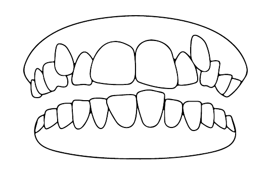 Dentes apinhados | Carreira Dental Clinic Dentes apinhados