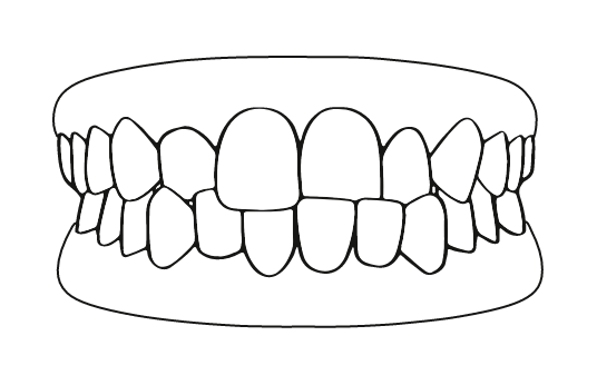 Mordida cruzada | Carreira Dental Clinic Mordida cruzada