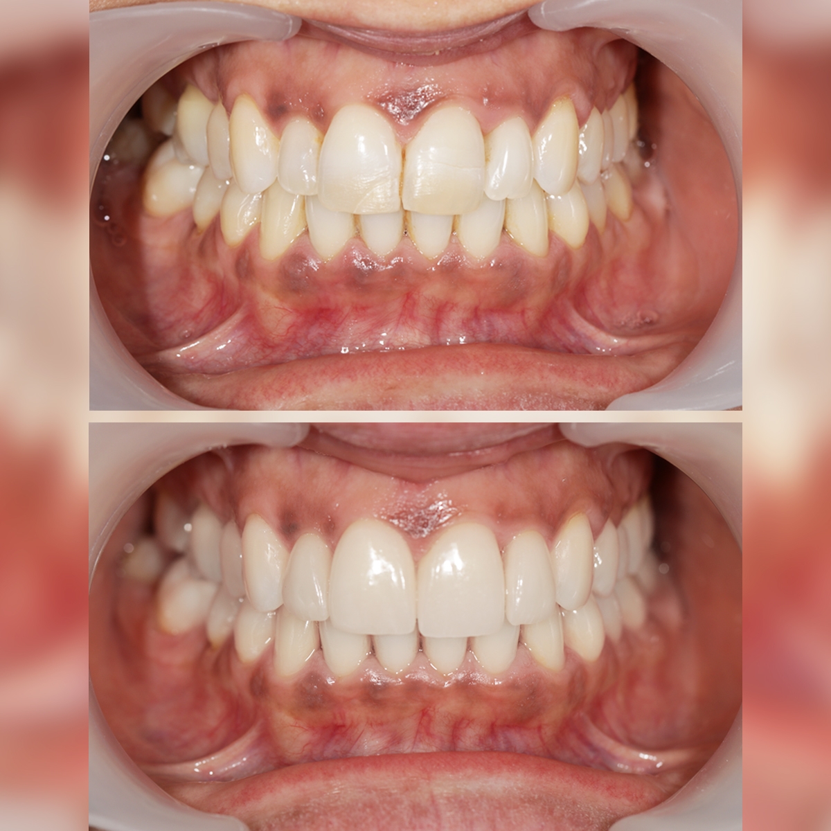 Colocação facetas dentárias