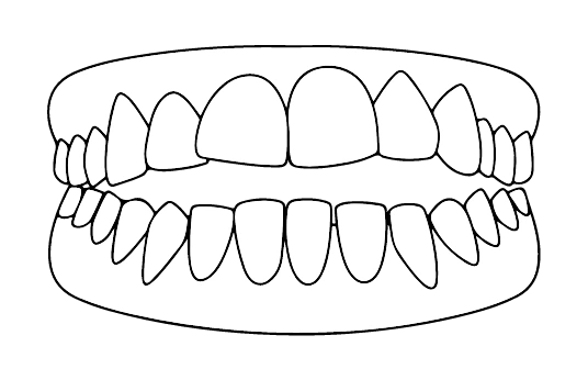 Mordida aberta | Carreira Dental Clinic Mordida aberta
