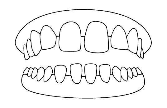 Diastema | Carreira Dental Clinic Diastema