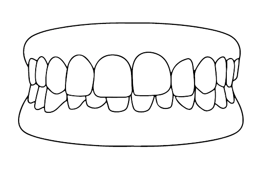 Sobremordida | Carreira Dental Clinic Sobremordida