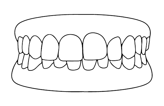 Sobremordida | Carreira Dental Clinic Sobremordida