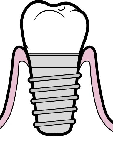 Peri-implantite | Carreira Dental Clinic Peri-implantite