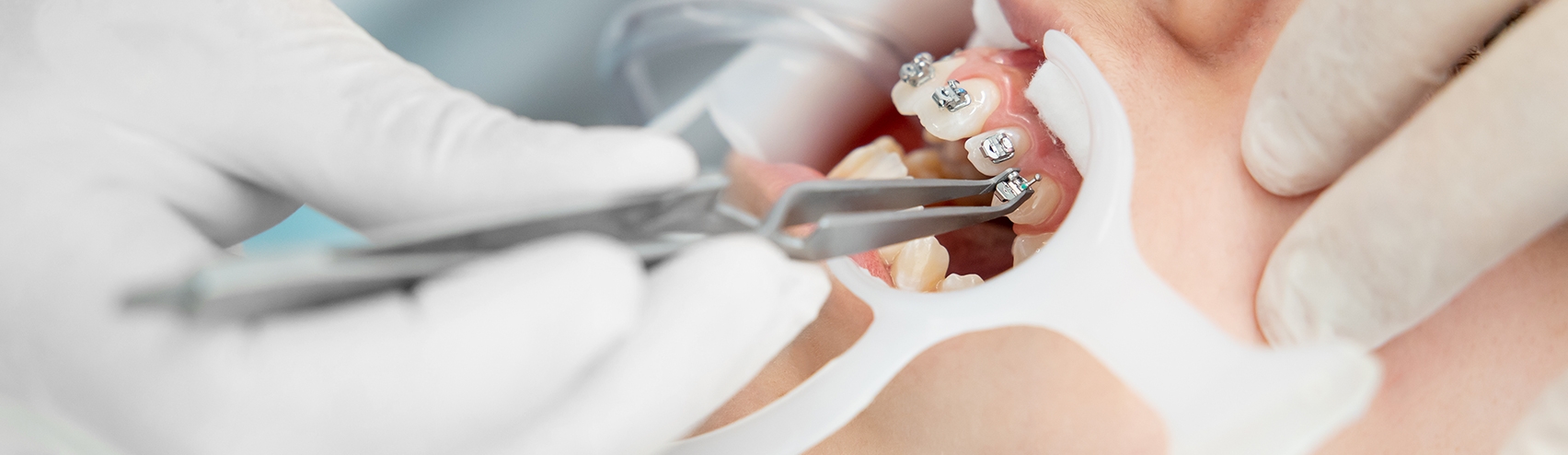 Consulta de ortodontia - Aparelho dentário