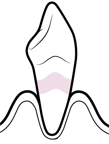 Dentina Exposta | Carreira Dental Clinic Dentina Exposta