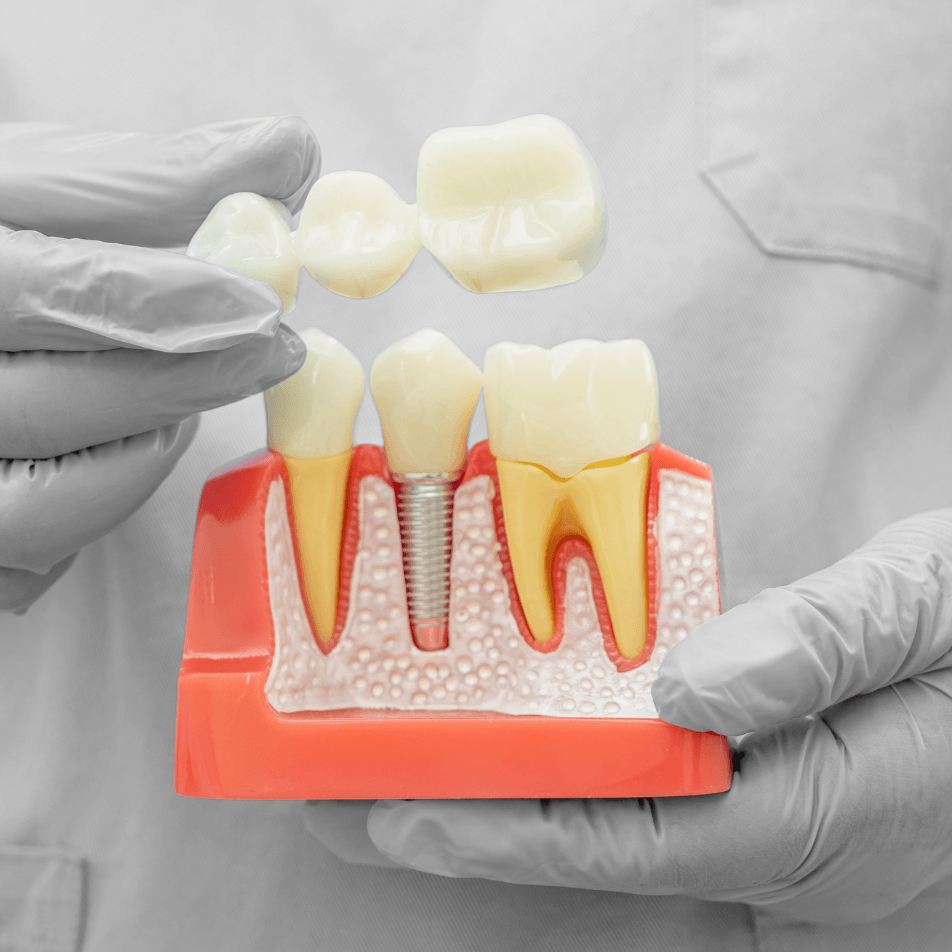 Colocação de coroas dentárias