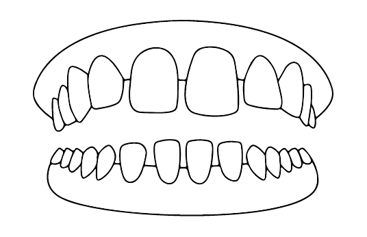 Diastema
